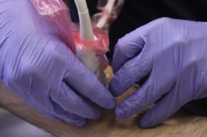 Fisioterapia punción seca Clínica Alhóndiga