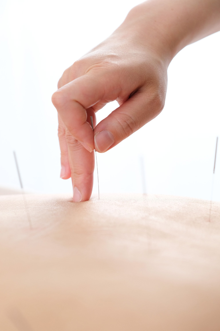 Fisioterapia Punción Seca con Clinica alhondiga en Indautxu Bilbao